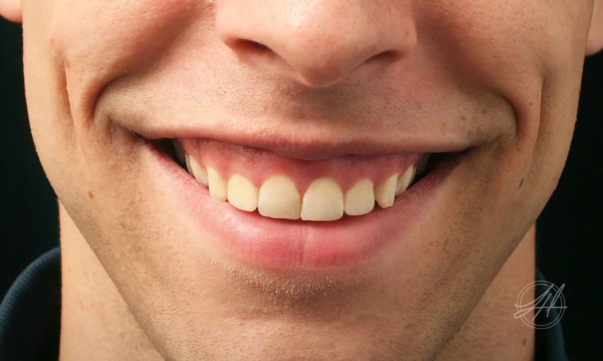 Gummy smile and aesthetic gum surgery
