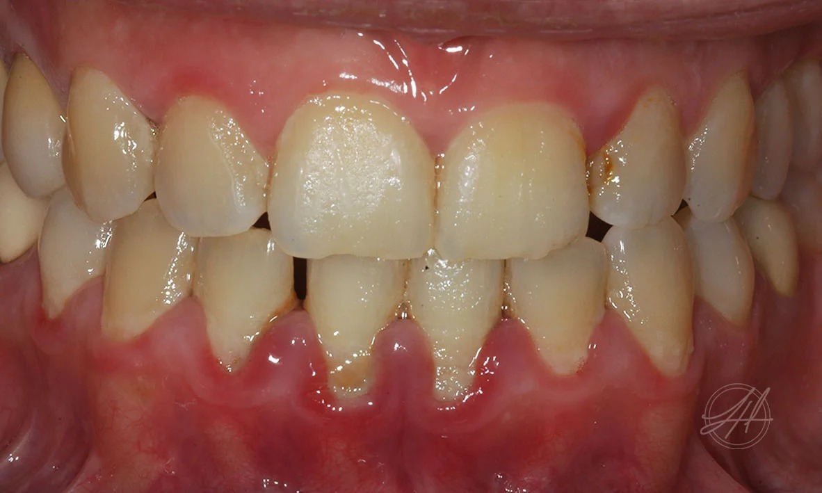 Gingivitis, the early stage of gum disease