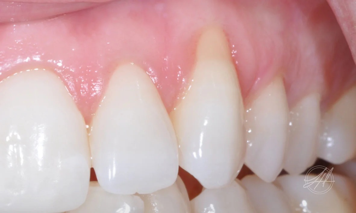 Gingival recession treated with gum grafting