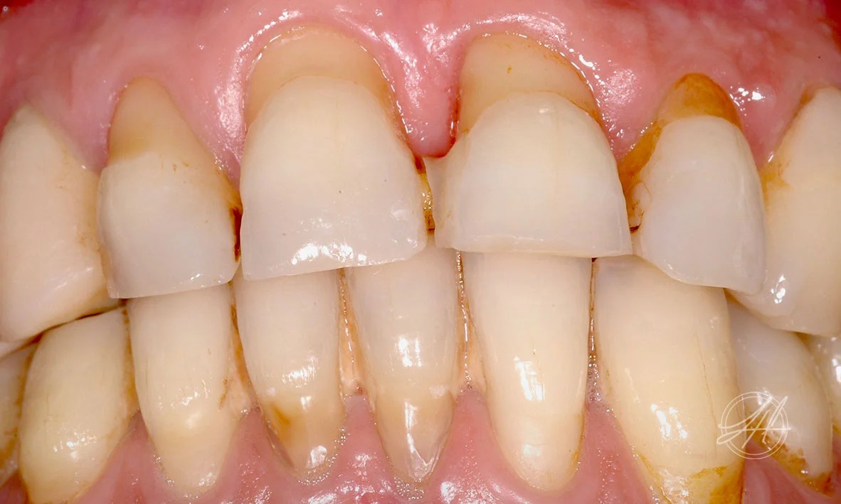 Periodontitis, advanced gum disease