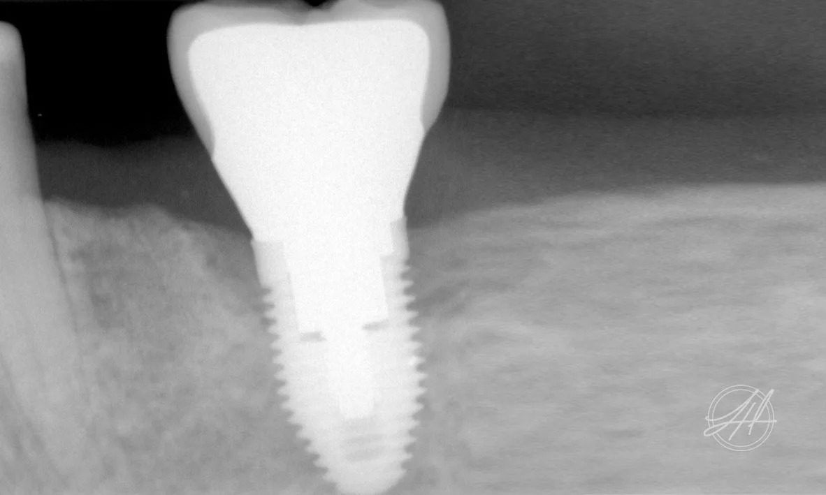 Peri-implantitis with bone loss around a dental implant