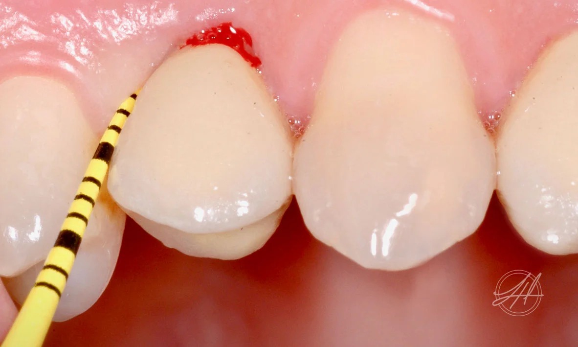 Peri-implant mucositis around a dental implant