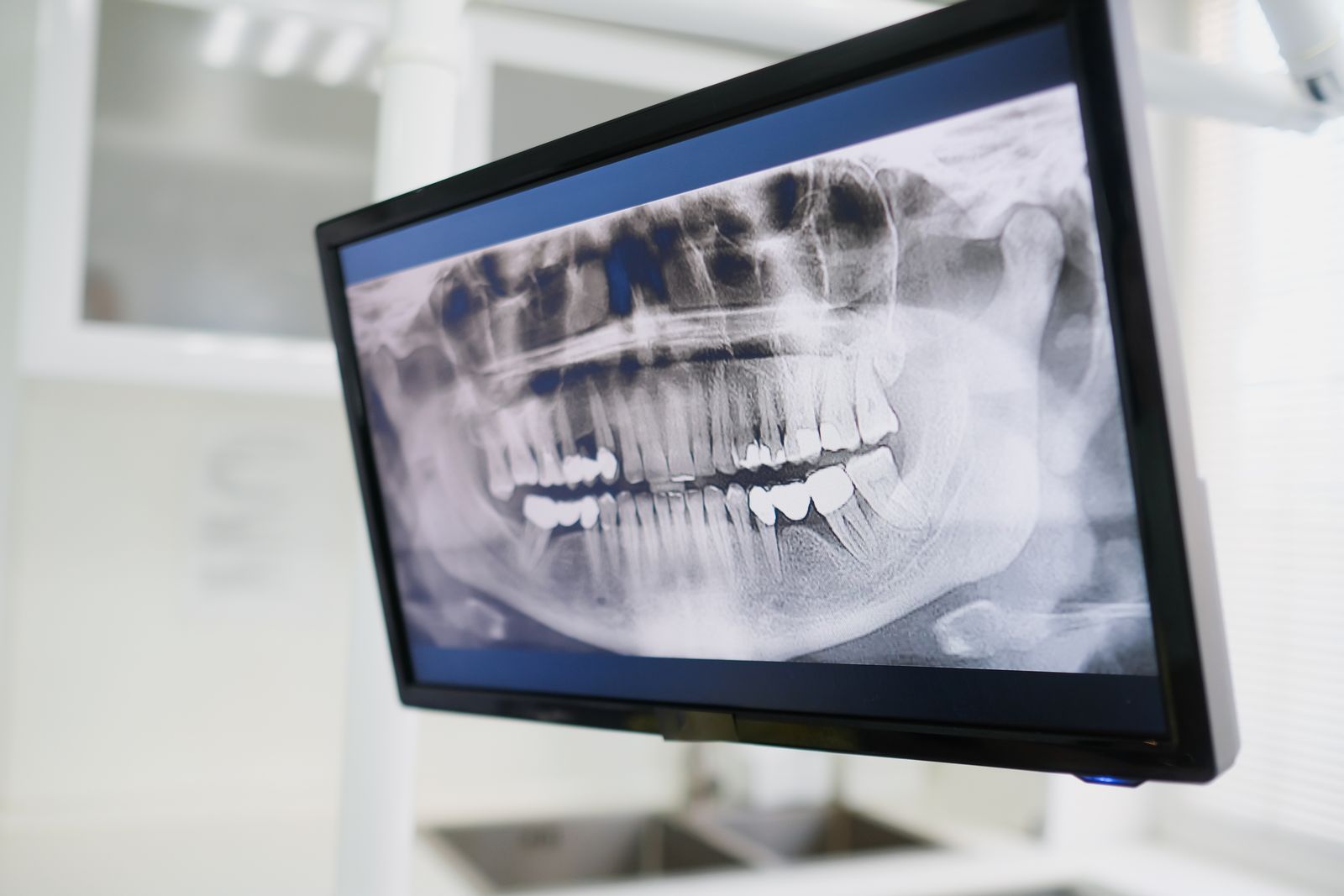A panoramic dental radiograph displayed on a monitor in a clinic